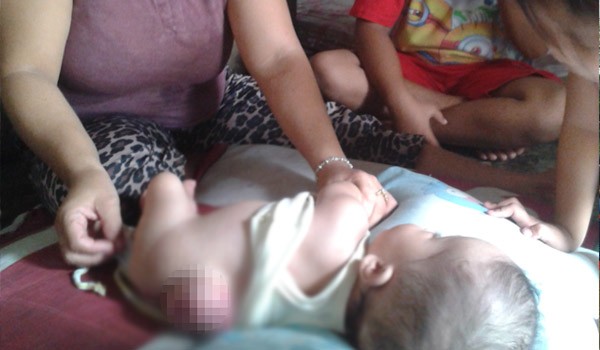 Immanuel Parningotan Hutasoit, Walau Masih Berumur 7 Bulan, Dia Harus Menderita 3 Penyakit Serius Sejak Lahir